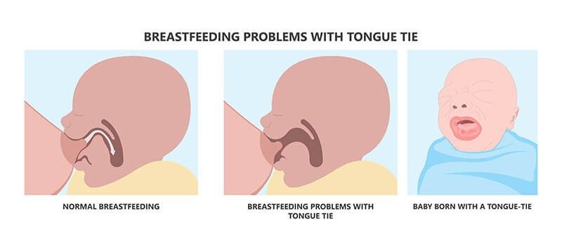 breastfeeding tongue-tie