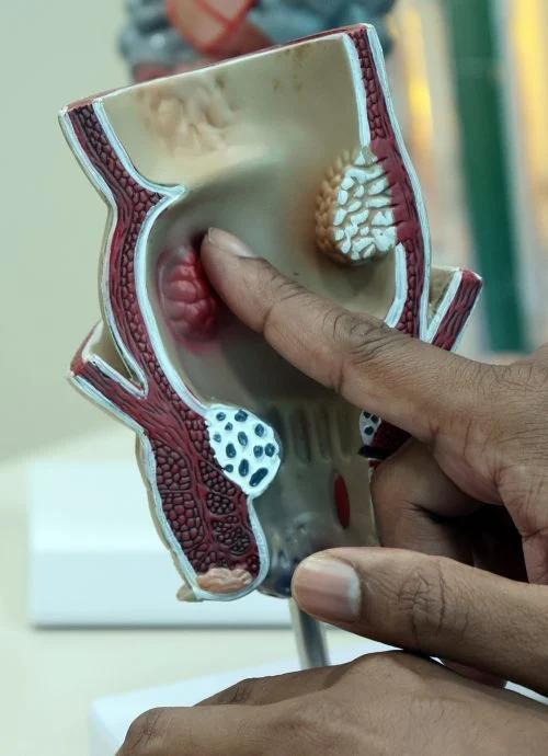 Rectal tumour usually causes per-rectal bleeding which often mis-diagnosed as haemorhoids.